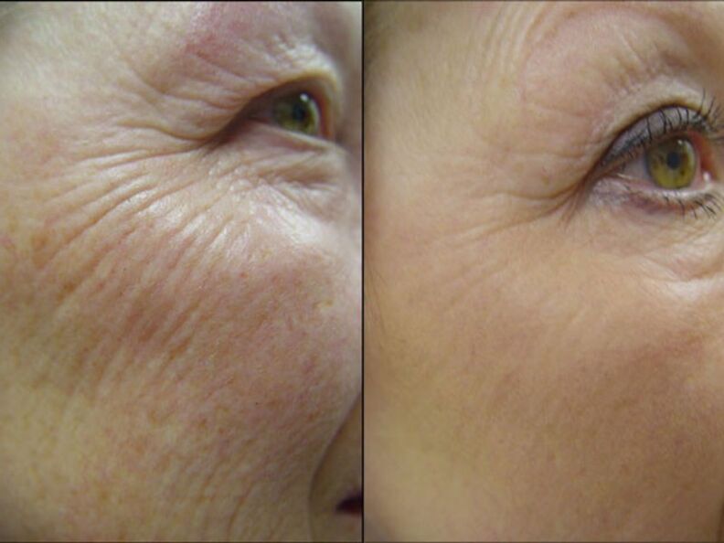 Bago at pagkatapos ng laser rejuvenation procedure - isang makabuluhang pagbawas sa mga wrinkles