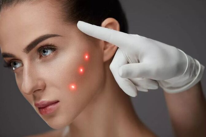 Laser Rejuvenation ng balat