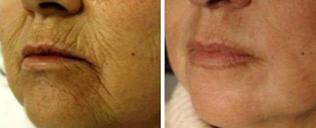 Rejuvenation 4d